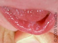 Thrush (Oral Candidiasis)