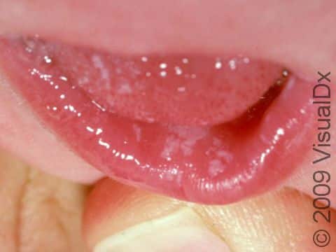 In oral candidiasis, normal mouth yeast overgrows, causing white, slightly elevated lesions.