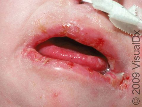 The overgrowth of yeast (candida) in this infant's mouth has caused cracking of the lips. The white lesions on the tongue are typical of candidiasis.
