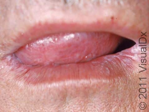 This image displays oral candidiasis (yeast infection) at the corners of the mouth.
