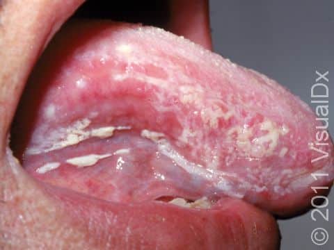 This image displays severe oral candidiasis (thrush) with thick, white lesions covering the tongue.