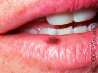 Oral Melanotic Macule