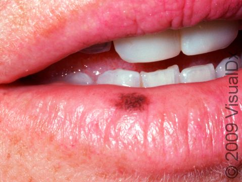 This image displays a persistent brown spot on the lips called an oral melanotic macule.