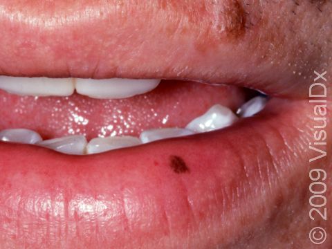Oral melanotic macules typically have an even, brown color with a regular border.