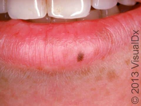 This image displays an oral melanotic macule in addition to freckling on the face.
