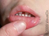 Oral Mucocele