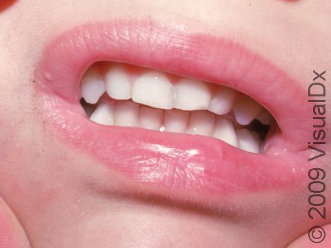A mucocele is causing the lower lip to have a slight bulge near the center.