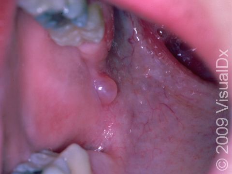 This image displays a mucocele inside the mouth.