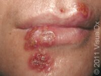 Cold Sores (Orofacial Herpes) – Adult