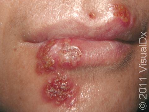 Grouped, crusted blisters on the lips and chin are typical of herpes simplex infection.