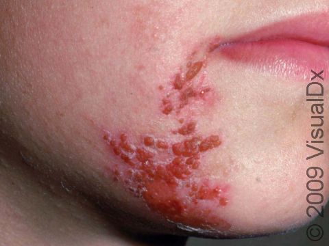 This image displays an unusual area for the herpes simplex infection.