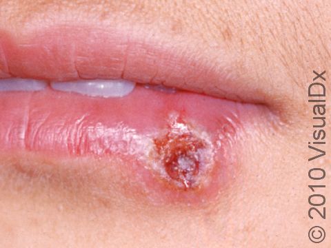 A slightly bloody crust has formed at the center of this herpes blister.