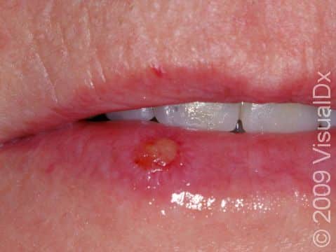 This image displays a mucosal blister caused by a herpes simplex infection.
