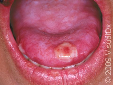 This image displays a herpes infection in a patient with a weak immune system, causing a severe, large oral or ulcer.
