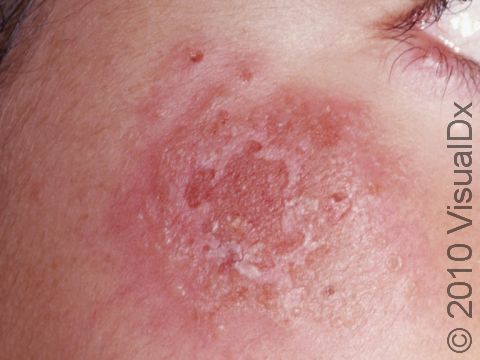 This image displays a herpes simplex infection on the face.