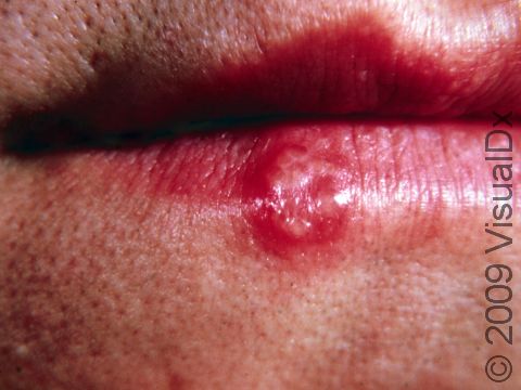 This image displays the fluid-filled blister typical of herpes.