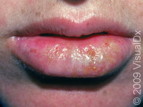 This image displays early crusting and swelling typical of recurrent herpes.