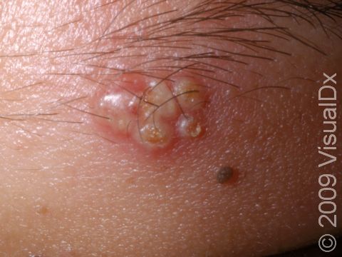This image displays multiple grouped herpes lesions that are starting to crust and dry.