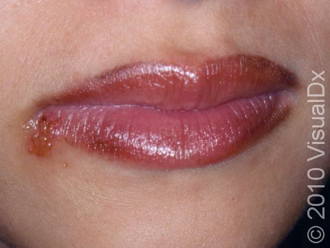 Small fluid-filled blisters typical of a herpes infection are present at the lateral lip.