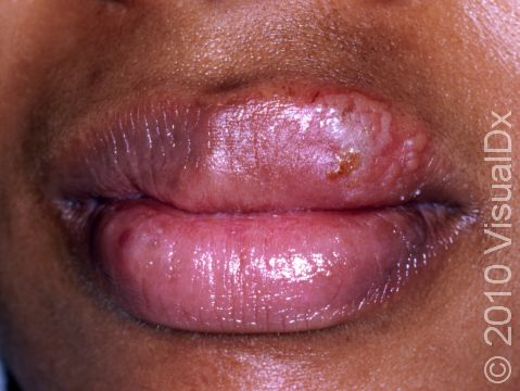Small blisters are early typical lesions of herpes simplex infection.