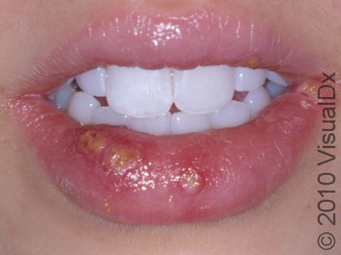 Lip blisters of herpes simplex infection can often have a yellow or gray color.