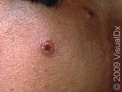 This image displays a blister with a central depression, typical of herpes simplex.