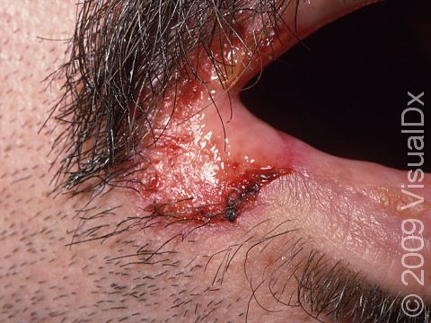 This image displays an ulcer from a herpes infection, which is typical of an immunocompromised person.