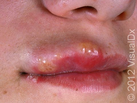 The first time a person contracts a herpes infection, there is often severe blistering, pain, and sometimes fever.