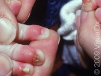 Nail Infection, Bacterial (Paronychia)