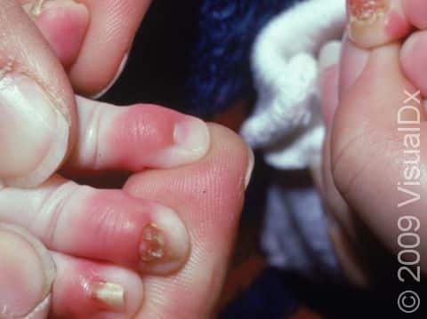 This image displays redness and swelling of the skin around the nails due to a chronic yeast infection; the nails seen here are short and lifting due to the chronic inflammation.