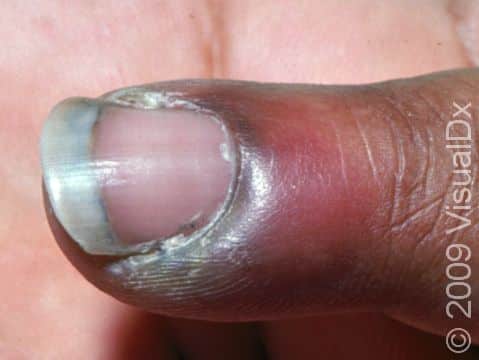 This image displays redness and swelling around the cuticle of the nail, typical of early paronychia.