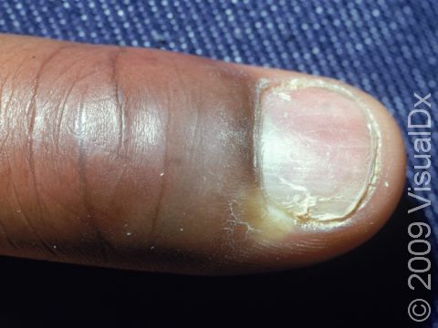 This image displays a collection of pus from an infection (paronychia) in the bottom part of the nail fold.