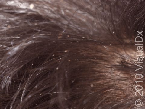 This image displays nits of lice on hair.