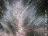 Head Lice (Pediculosis Capitis) – Child