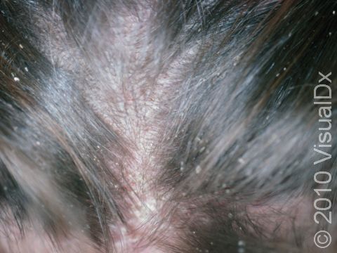 Head Lice (Pediculosis Capitis) Condition, Treatments and Pictures for  Children - Skinsight