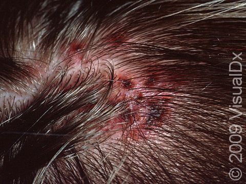 This image displays sores and bloody crusts from scratching due to pediculosis capitis (head lice).