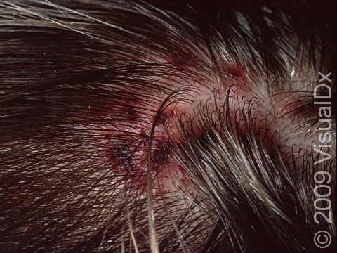 Lice (pediculosis capitis) can cause intense itching, which can result in scratching and areas of bloody skin crusts, as seen in this image.