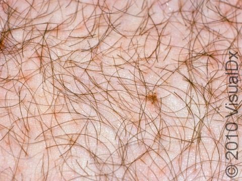 This image displays pubic lice (seen near the center on the right).