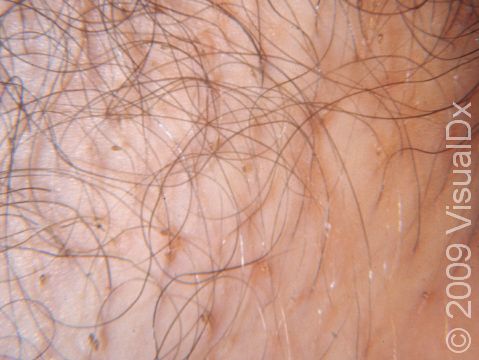 This image displays pubic lice and eggs attached to hair.