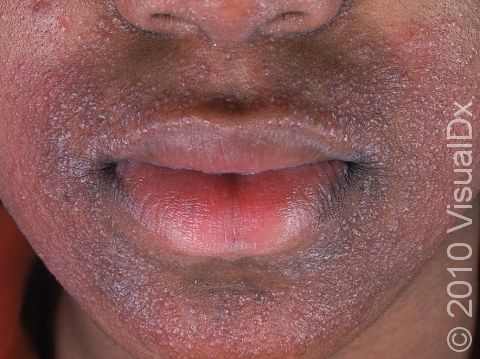 This image displays numerous tiny, pus-filled lesions around the mouth and nose.