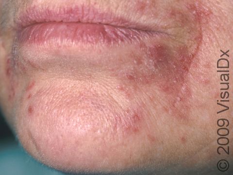 In perioral dermatitis, small raised bumps can merge together to form larger red, elevated lesions.