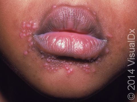 This image displays a child with pus-filled lesions around the mouth typical of perioral dermatitis.