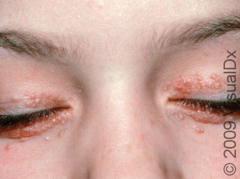 Perioral dermatitis can affect the eyelids as well as the skin around the mouth.