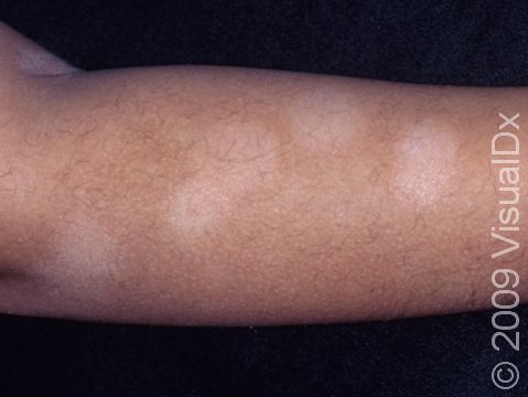There may be numerous flat, lighter-colored, non-scaling areas with pityriasis alba.