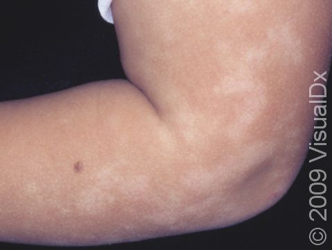 On this child, the lighter-colored flat spots of pityriasis alba are joining together to form large irregular patches.