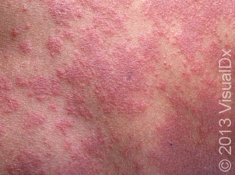 In severe pityriasis rosea, numerous small bumps may run together.