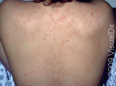 This image displays a typical site of involvement for pityriasis rosea, displayed as light pink, scaly, slightly elevated lesions.
