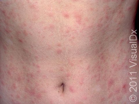 Pityriasis rosea typically involves the chest, back, and abdomen. Typical lesions have a very fine, scaly surface.