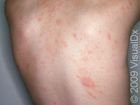 This image displays a rash on the patient's trunk typical of pityriasis rosea.