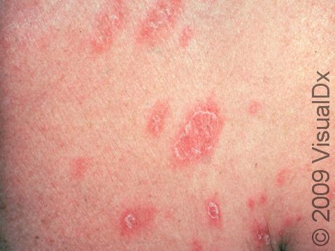 The patches of pityriasis rosea are typically oval, often parallel to each other, and may have an edge of scaling at the outside border.